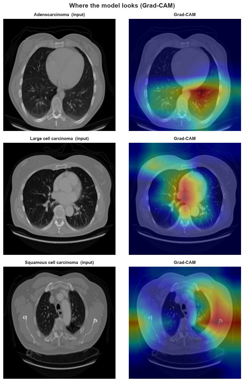 Grad-CAM heatmaps overlaid on CT scans.