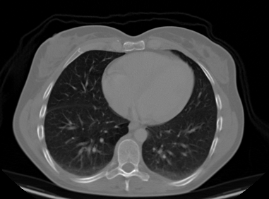 Chest CT slice